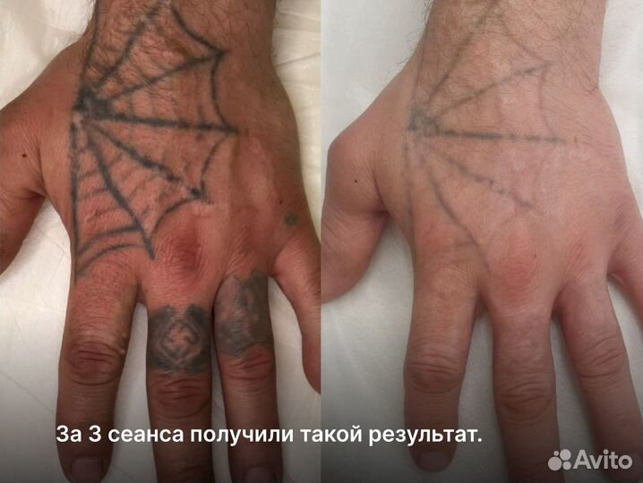 Лазерное удаление тату