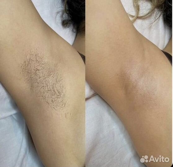 Лазерная эпиляция