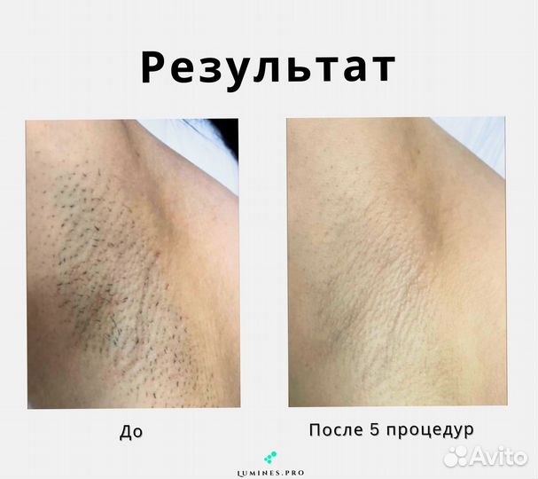 Аппарат для эпиляции Люминес. Макс Ван 1200 Вт