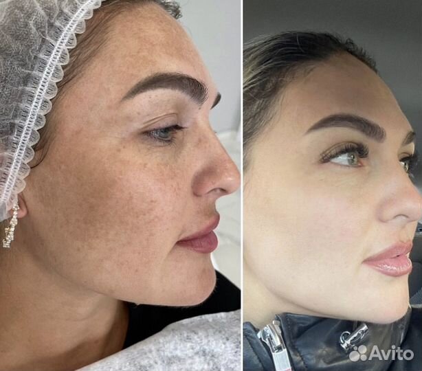 Фотоомоложение лица на IPL lumecca