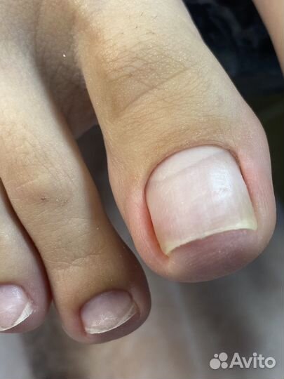 Вросший ноготь, грибок. педикюр