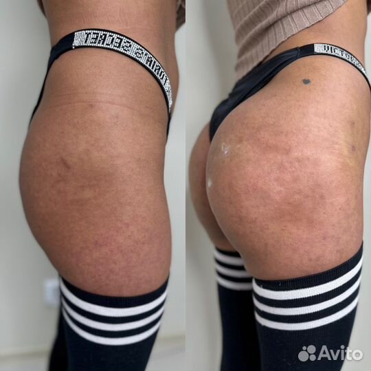 Увеличение ягодиц/ груди/ интимная пластика