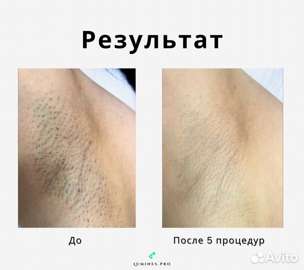 Диодный лазер для эпиляции Lumines. Макс’Ван 1200вт