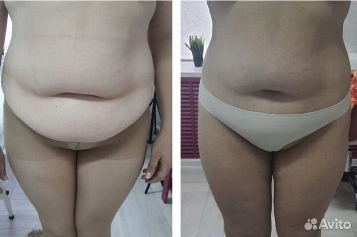 Плоский живот - размер за 1 процедуру.Криолиполиз