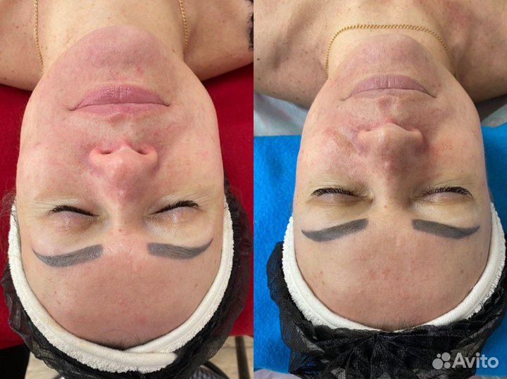 Скульптурный массаж лица