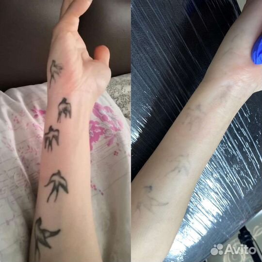 Удаление татуировок и татуажа. Карбоновый пилинг