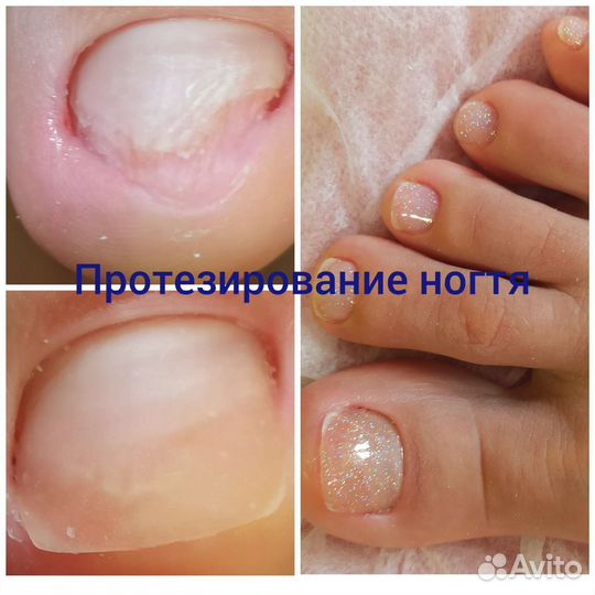 Подология, педикюр