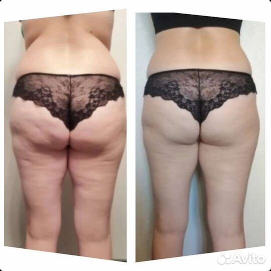 Lpg массажа антицеллюлитный массаж