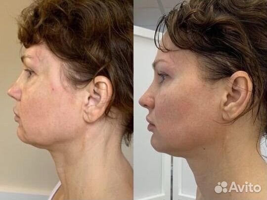 Скульптурный массаж лица. Буккальный