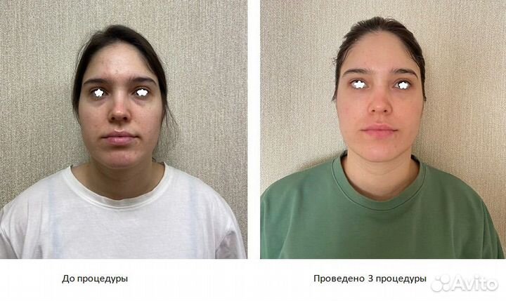 Ручная пластика лица