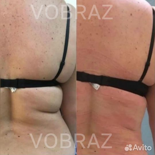 Аппаратная коррекция фигуры (программы похудения)