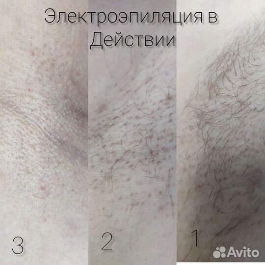 Электроэпиляция апилус в 4 руки