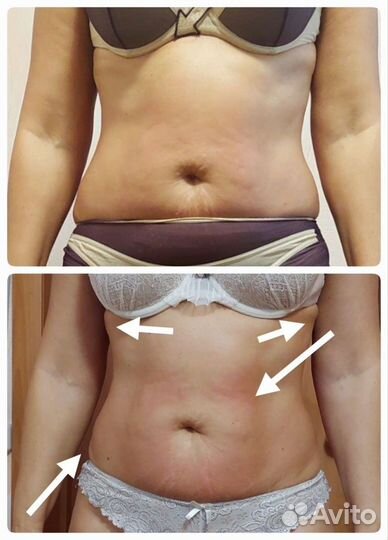 Антицеллюлитный массаж, коррекция фигуры