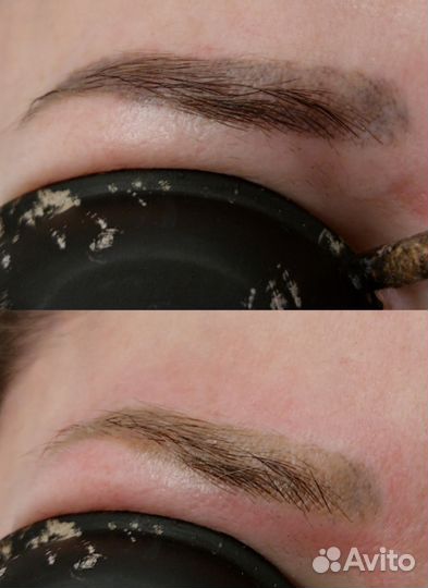 Лазерное удаление татуажа