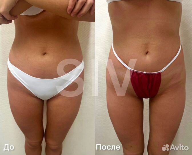 Коррекция фигуры /Lpg массаж/Кавитация/ Rf-лифтинг