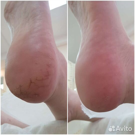 SMART - педикюр