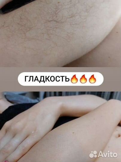 Шугаринг,электроэпиляция,брови