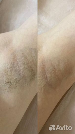 Депиляция Шугаринг