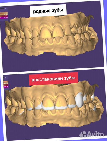 Накладные виниры на зубы