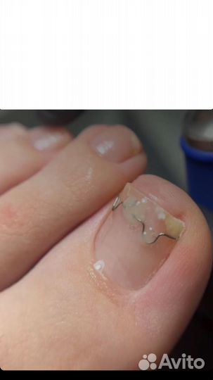 Протезирование ногтя. Титановая нить. Подолог