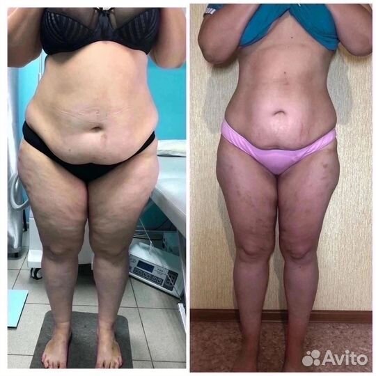 Криолиполиз/ безоперационная липосакция