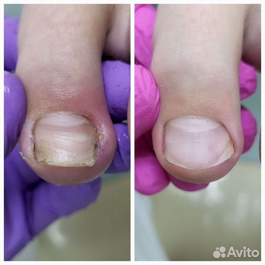 Коррекция вросшего ногтя