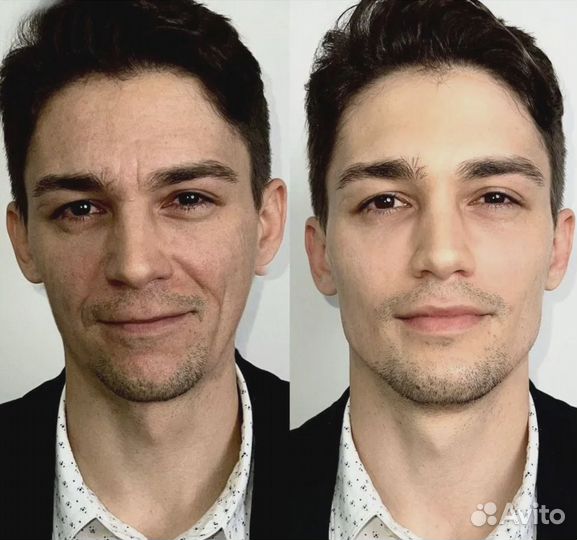 Подтяжка лица за 1 процедуру. СМАС лифтинг