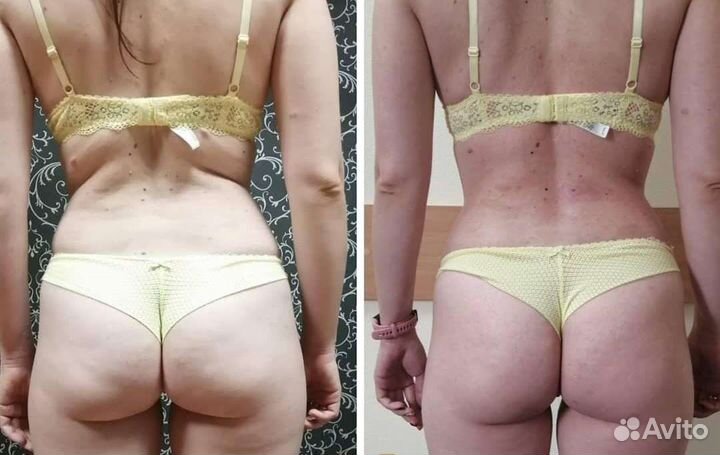 Антицеллюлитный массаж, массаж тела