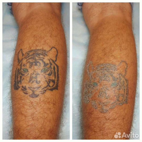 Удаление Татуировок Татуажа