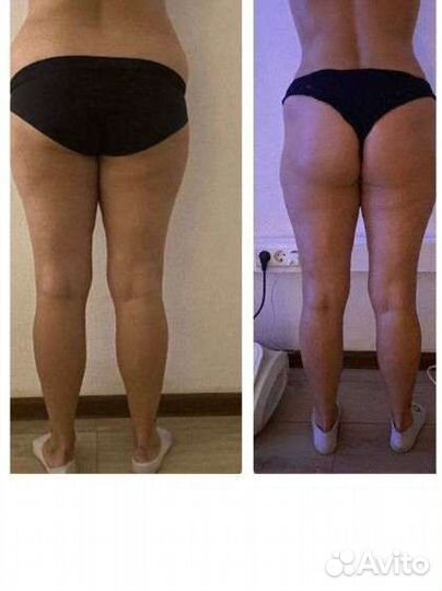 Аппаратный массаж, жиротоп