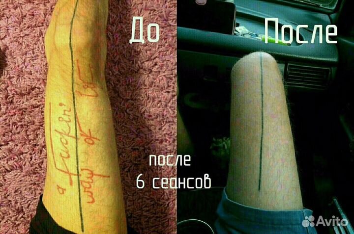 Удаление тату и татуажа