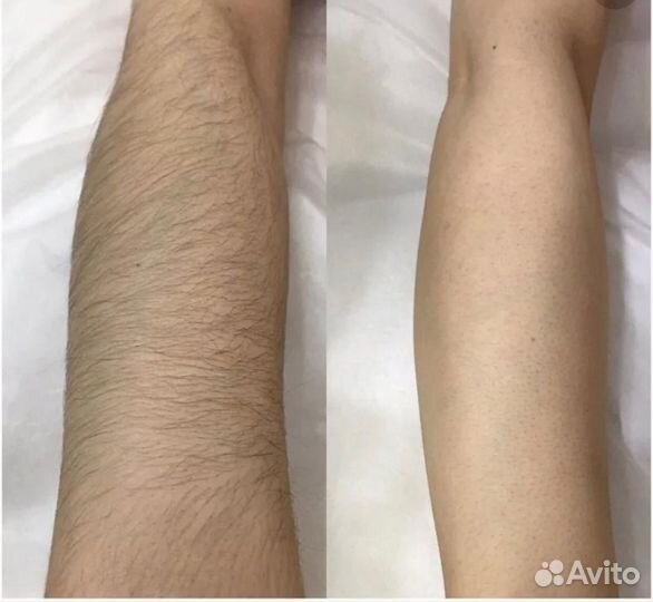 Лазерная эпиляция