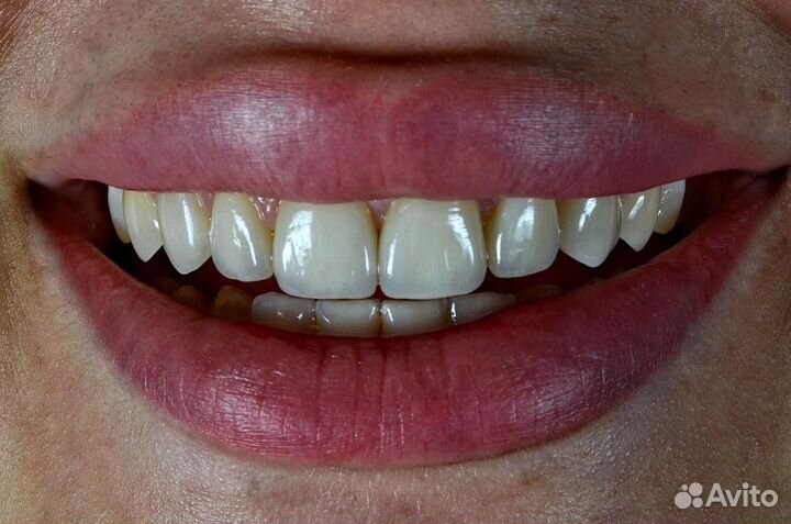 Эстетическое и Функциональное Протезирование