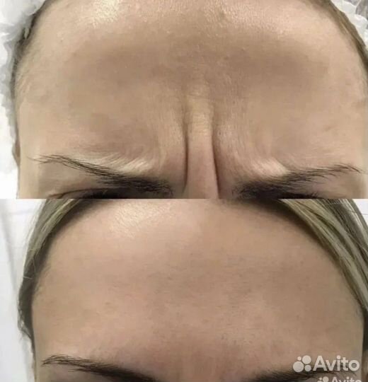 Врач косметолог услуги. Ботокс, филлеры