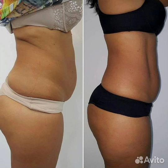 Криолиполиз