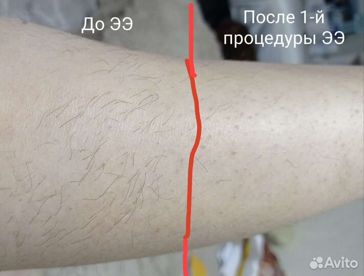 Электроэпиляции,шугаринг,ваксинг