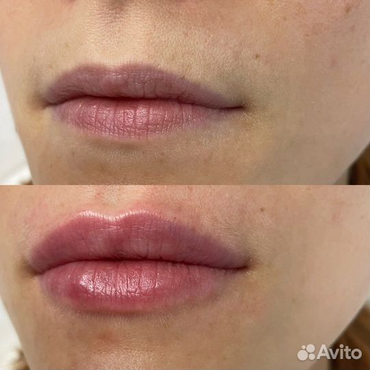 Косметолог, ботокс для лица, увеличение губ