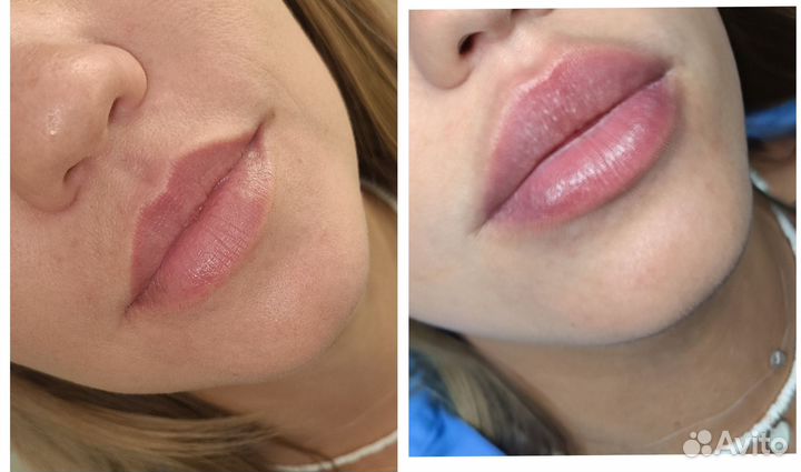 Увеличение губ