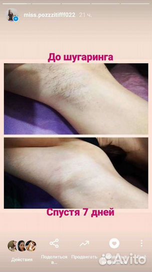 Сахарная депиляция/Шугаринг