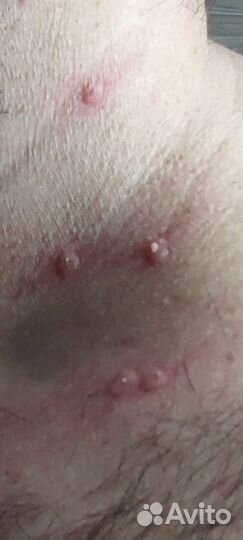 Удаление папиллом, бородавок