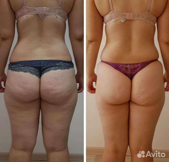 Антицеллюлитный массаж тела