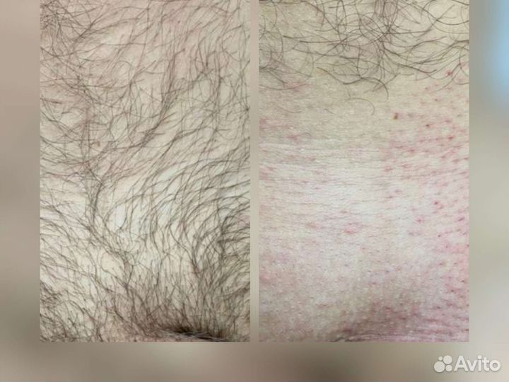 Депиляция воском: глубокое бикини