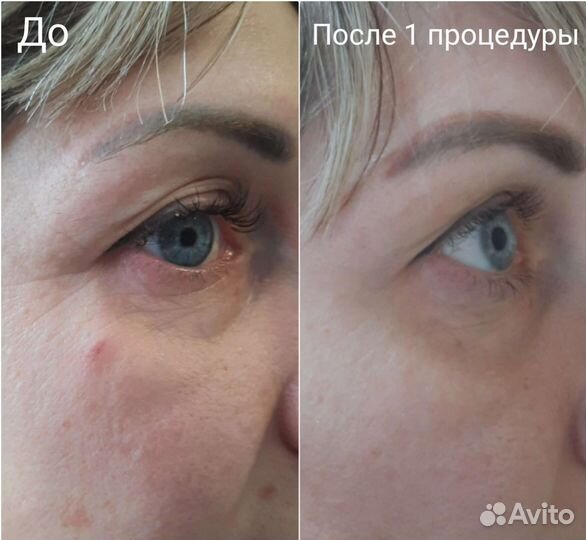 Холодная плазма