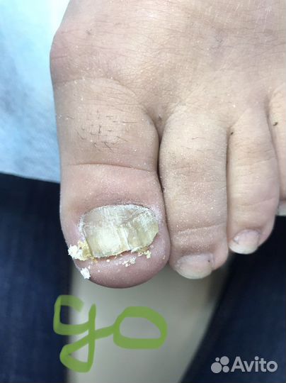 Педикюр подолог