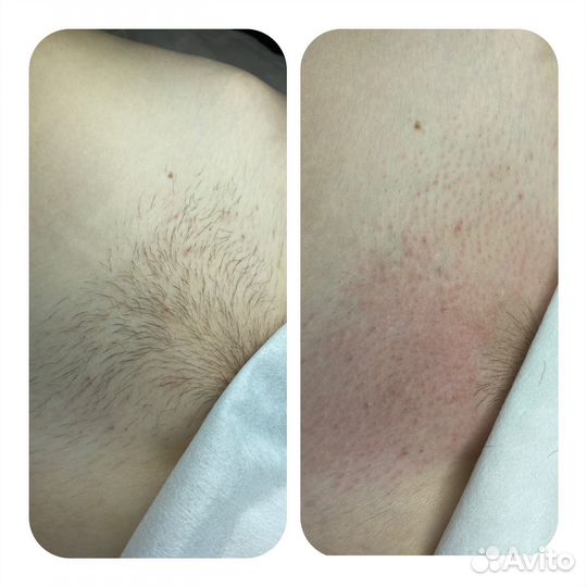 Электроэпиляция