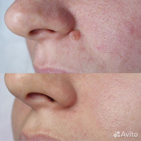 Удаление новообразований