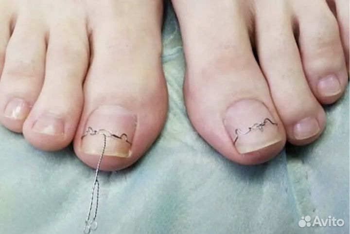 Услуги подолога- коррекция вросших ногтей