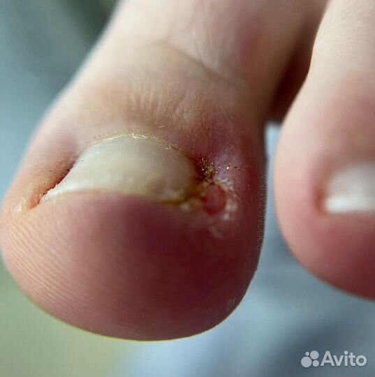 Модель подологу вросшие ногти трещины травмы