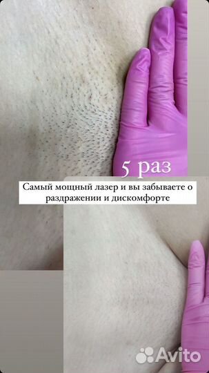 Лазерная эпиляция