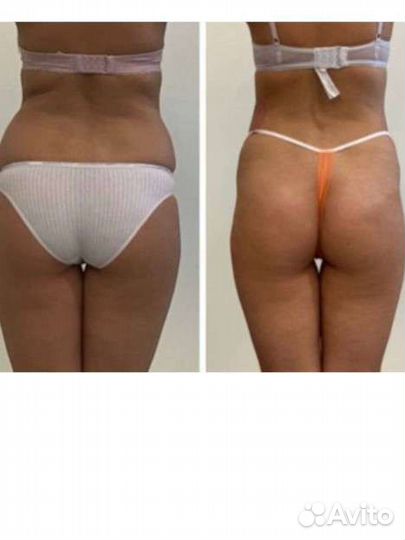 Аппаратный массаж, жиротоп